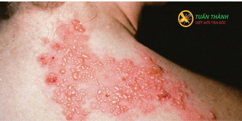 Trẻ em bị kiến ba khoang đốt nên làm gì?